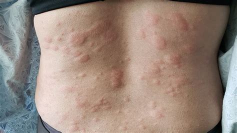 Hives Vs Rash Here S How To Tell The Difference The Healthy - Riset