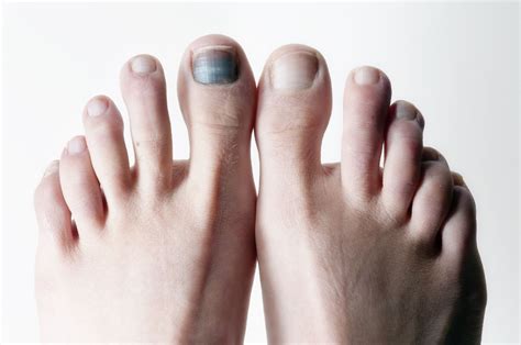 Black Toenails: Causes, Prevention Tips, And How To Treat | lupon.gov.ph