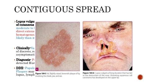 Cutaneous tuberculosis