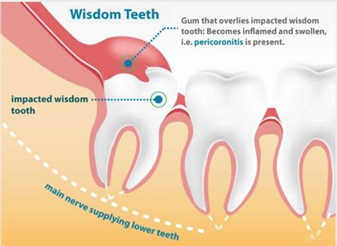 Wisdom Teeth Symptoms