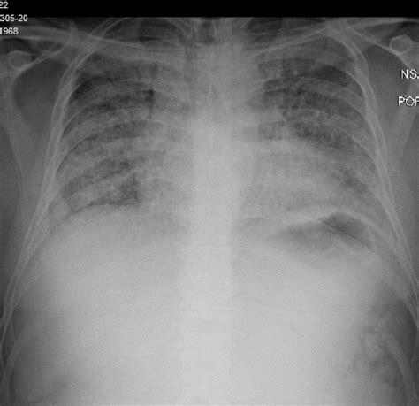 COVID-19 and Spontaneous Pneumomediastinum: A Case Series