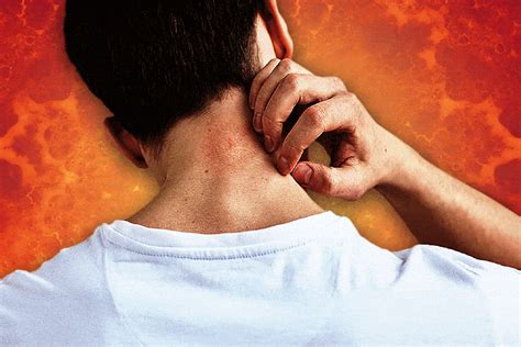 What is a stress rash? How to manage hives caused by anxiety - seemayo