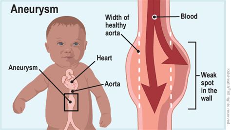 Aortic Aneurysm | Rady Children's Hospital