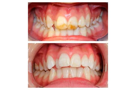 Understanding Enamel Hypoplasia, Causes & Treatment