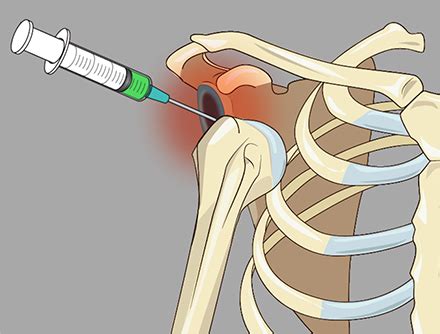 Intra-articular Shoulder Injection Following Shoulder Dislocation | Emergency Medicine and ...