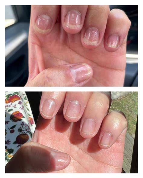 I’ve been most surprised at the nail bed growth! The top is a couple months into the journey and ...