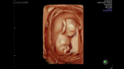 Baby Hallak #3 || 3D 4D Ultrasound at 12 Weeks Pregnant - YouTube