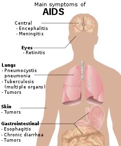 AIDS - Wiktionary, the free dictionary