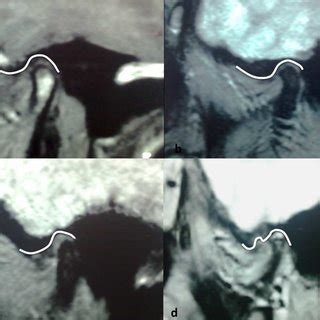 (PDF) Evaluation of Articular Eminence Morphology and Inclination in ...