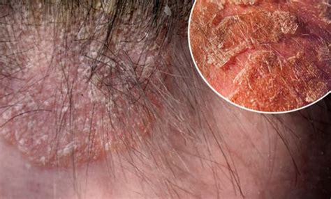 Eczema | Hairloss Causes