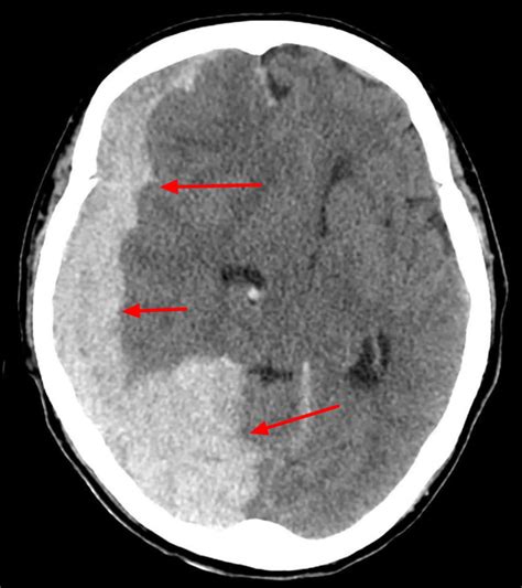 Hematoma, subdural hematoma causes, diagnosis & hematoma treatment