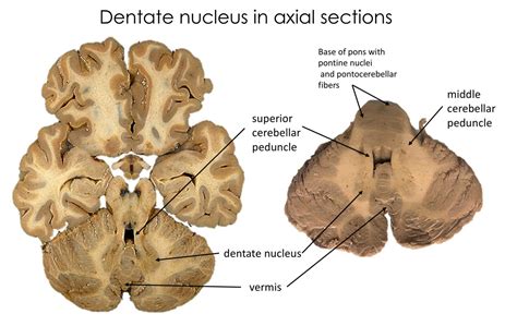 Lab Week 5: Basal Ganglia and Cerebellum – Rehab 551 Lab