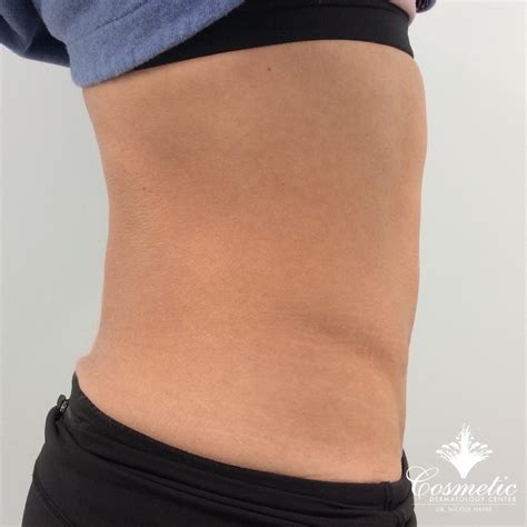 Emsculpt® Muscle Toning and Fat Reduction - Cosmetic Dermatology Center