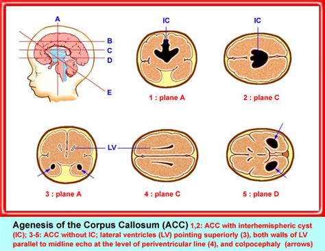 Agenesis of the corpus callosum – Department of Obstetrics and ...