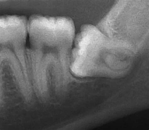 Wisdom Tooth Extraction Prevents Tooth Crowding and Infections ...