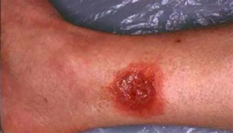 Wolf Spider Bite Pictures, Symptoms, What it Looks Like on Dog, Cat ...