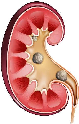 Kidney Stones Causes, Ayurvedic Treatment & Remedies - Yogveda