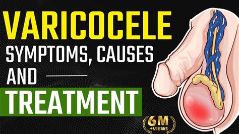 Varicocele -Symptoms, Causes and Treatment | Varicocele Natural Treatment | Testis Pain Relief ...