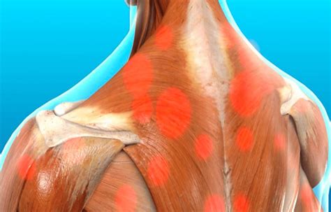 Myofascial Trigger Pain Affecting The Trapezius Muscle - Chiropractic ...