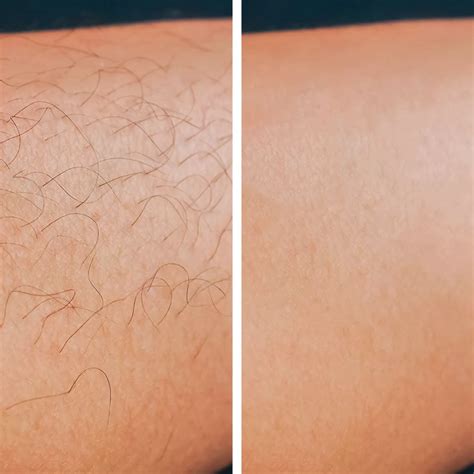 How Long Before Laser Hair Removal Should You Shave Clearance ...