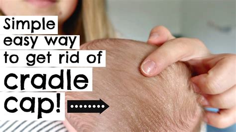 HOW TO GET RID OF CRADLE CAP IN ONE TRY! || NEWBORN - YouTube