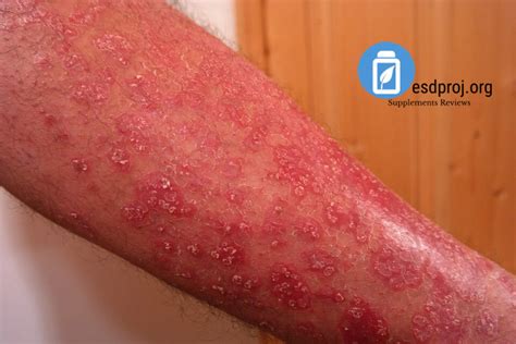 Psoriasis Treatments: Soriatane Medication, Dosage, Side Effects And Treatments - Eating, Sport ...