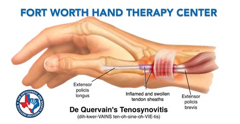 De Quervain’s Tenosynovitis - Chronic Overuse and Strain on the Wrist