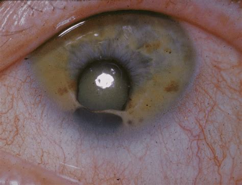 cat eye syndrome : Biological Science Picture Directory – Pulpbits.net