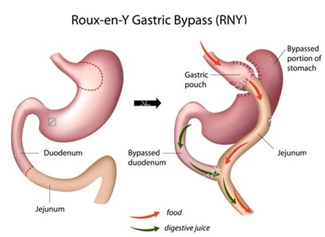 Roux-en-Y Gastric Bypass - Dr.Amit Garg