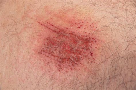 Abrasion Wound in Caucasian Skin Close Up Stock Image - Image of human ...