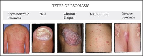 Jenis-jenis Psoriasis dan Komplikasinya | Key Coordinator Shaklee & Pengedar Shaklee Terbaik ...