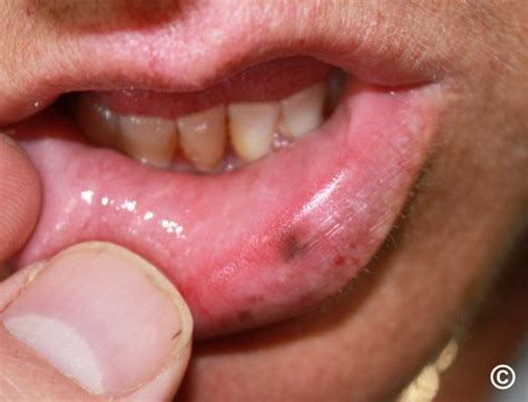 Mucosal melanocytic macules