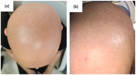 Clinical findings prior to treatment with deucravacitinib. (a ...