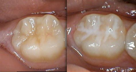 What are Fissure Sealants? - Crestmead Dental