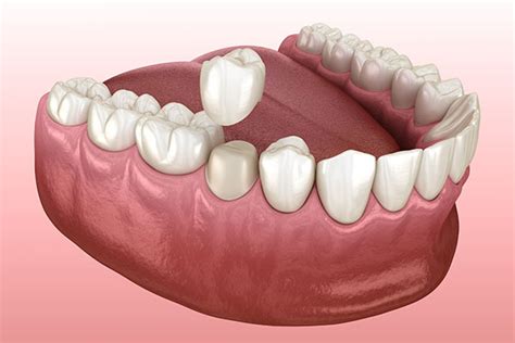 Does a Dental Crown Help After a Root Canal?