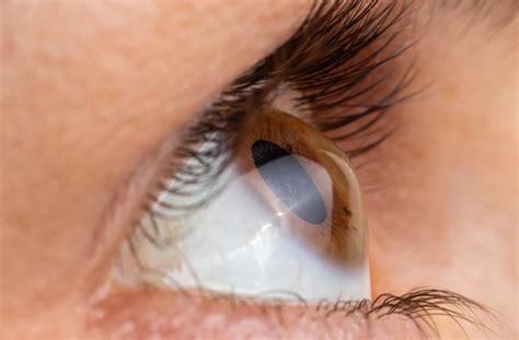 Can Keratoconus Be Cured?｜Spanish Fort