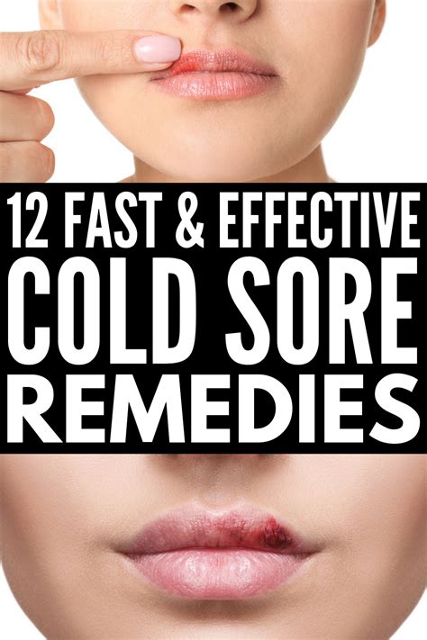 Natural Cold Sore Remedy, Healing Cold Sore, Natural Cures, Diy Cold Sore Remedy Fast, Cold Sore ...