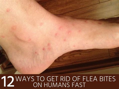 Flea Bites That Look Like Mosquito Bites While mosquitoes don t have any venom of their own they ...