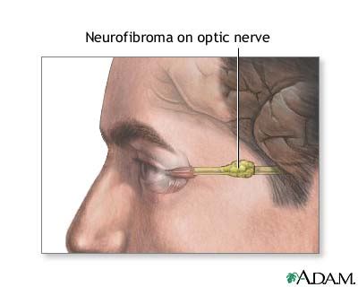 Neurofibromatosis-1: Treatment – Health32