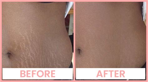 Laser Stretch Mark Removal in Chandigarh