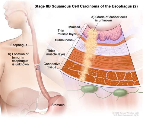 Esophageal Cancer | Vanderbilt-Ingram Cancer Center