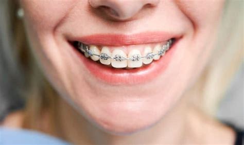 Initial Consultation & Evaluation for Getting Braces - Expert Advice