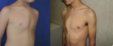 Superior PC without features of Currarino-Silverman syndrome (left ...