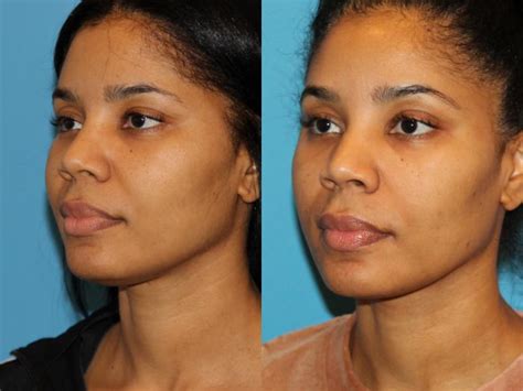 Neck Lift (Submentoplasty) Before and After Pictures Case 94 | Atlanta, Georgia | Buckhead ...