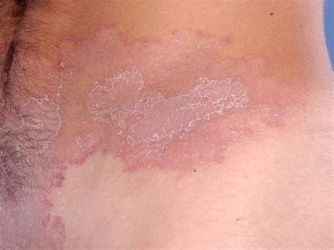 Ringworm Tinea Corporis Treatment