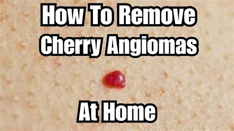 DIY Removing Cherry Angiomas at Home - YouTube