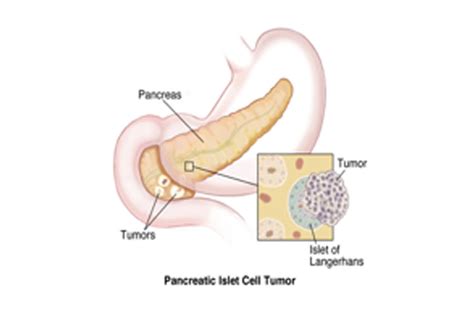 Islet Cell Cancer