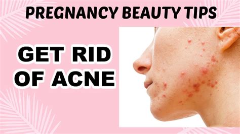 GET RID OF ACNE | PREGNANCY BEAUTY TIPS - YouTube