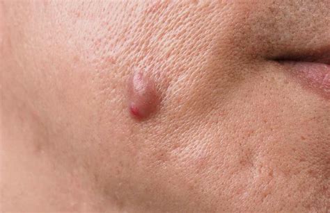 Cystic Acne – What it is, Causes & Treatment - Ensoul Medical Clinic