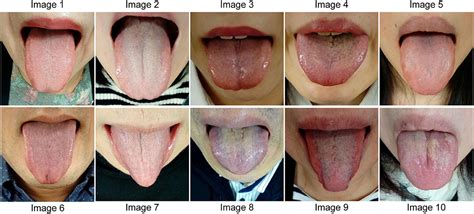 Frontiers | Construction of a Standardized Tongue Image Database for ...